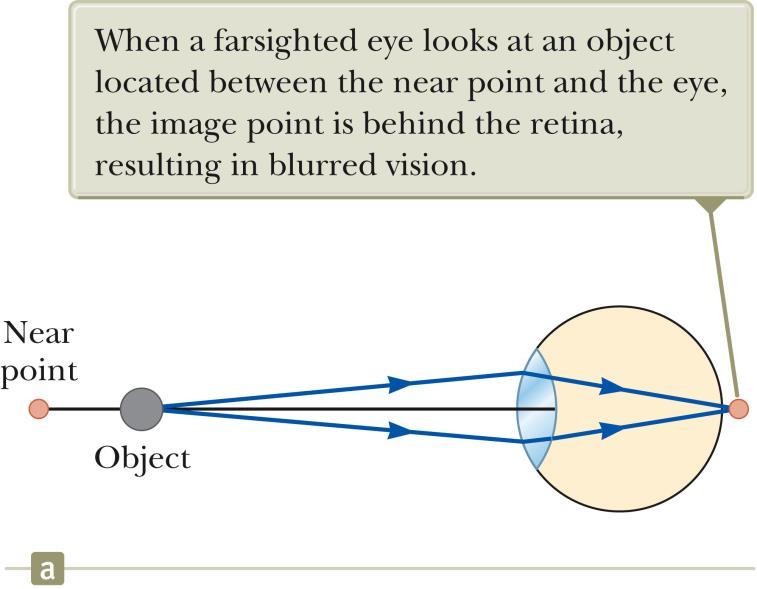 Farsightedness Also called hyperopia The near point of the farsighted person is much farther away than that of the
