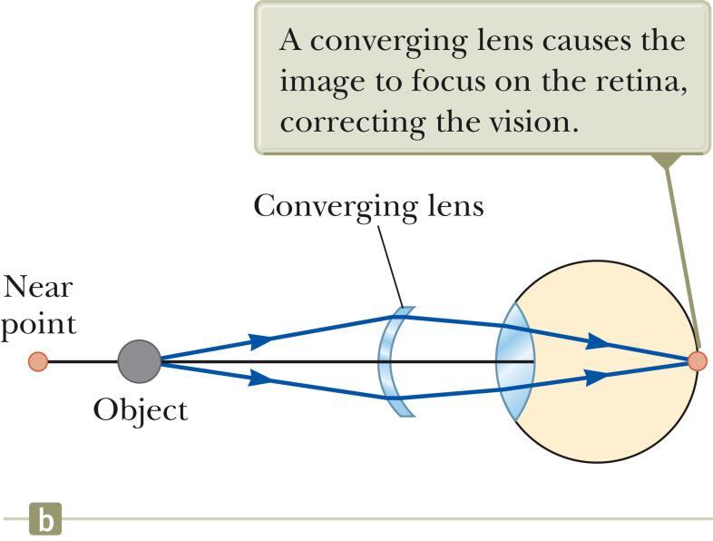 Correcting Farsightedness A converging lens placed in front of the eye can correct the condition.