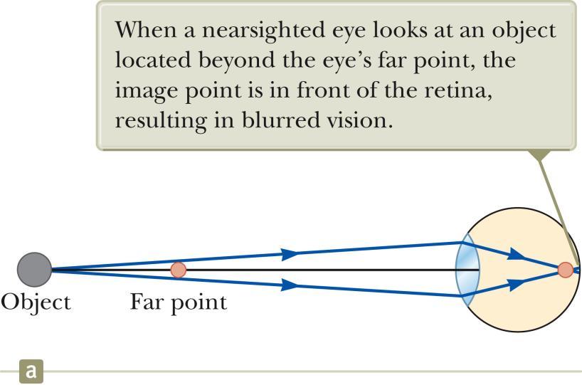 Nearsightedness Also called myopia The far point of the nearsighted person is not infinity and may be
