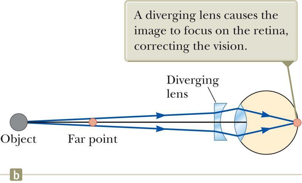 Correcting Nearsightedness A diverging lens can be used to correct the condition.