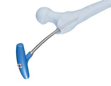 505) For use with tibia nails For use with