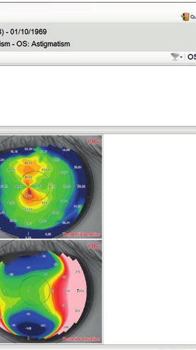 pachymetry map and corneal altimetric
