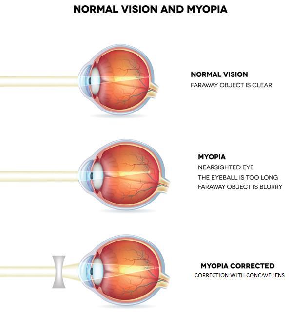This defect is usually found in young people. Hypermetropia or long-sightedness.