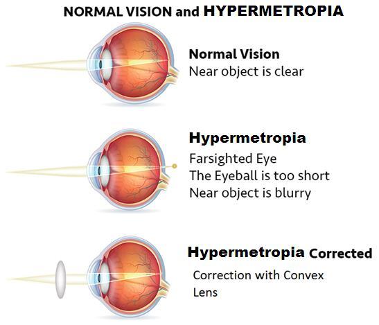 Nearby objects cannot be seen because the images of these objects are formed not on the retina, but behind the retina.