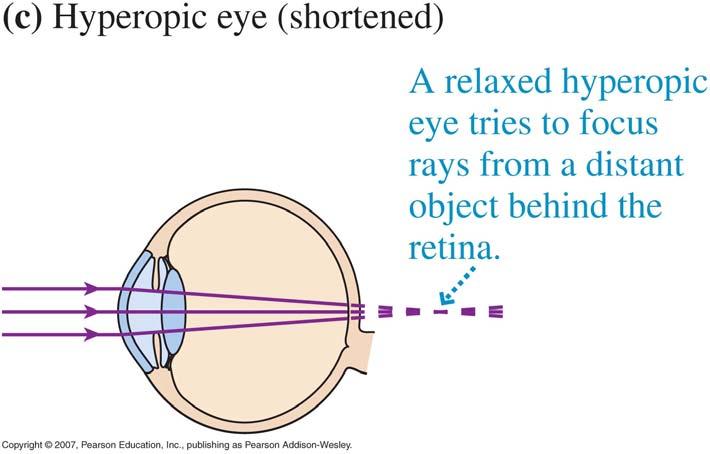 Farsightedness Farsightedness (or hyperopia) occurs when the eye cannot focus on objects that are nearby.
