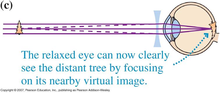 This can be achieved with the aid of a diverging lens (glasses or contacts).