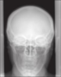 Figure 1.12 Radiography of the skull. Low-pass filtered image with a Gaussian filter (20 20 pixels, σ = 15). (c) High-pass filtered image obtained by subtracting from.