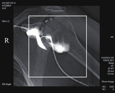 Prospective and retrospective fluoroscopic record/ store can be used to replace digital acquisition (DA), resulting in significant dose reduction.