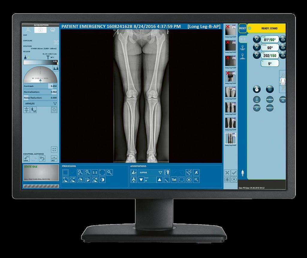 Featuring ddraura s stitching function, it utilizes a single focus stitching technique for orthopedic studies such as scoliosis and long leg imaging.