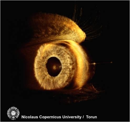 an eye after corneal transplantation OCT image of anterior