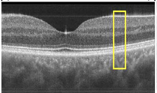 Retinal/AS Images with