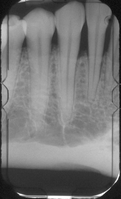 Proper Film Positioning Step 1: Proper Film Positioning Film placement for proper anatomic coverage is beyond the scope of this pamphlet and can be reviewed in any quality dental radiography text.