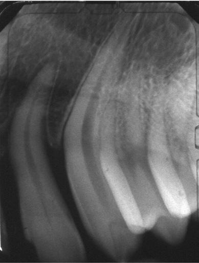These problems occur due to the fact that dental radiography is a shadow casting technique. In other words, we cast an image of the tooth onto the film.