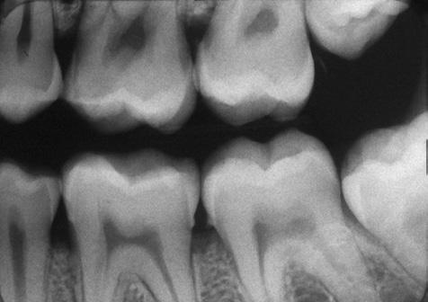 This commonly occurs when the film is not placed far enough in the center of the mouth and the film must be angulated to avoid the slope of the palate or the mandibular vestibule.