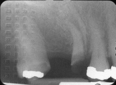 Due to the attenuation of the foil, the radiograph also appears overall light in density.