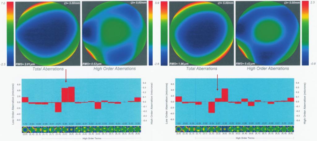 FIGURE 3S. Wavefront analysis of a patient implanted with AcrySofIQ in right eye 1 and 3 months postoperative, showing trefoil 9 reduction. FIGURE 4S.