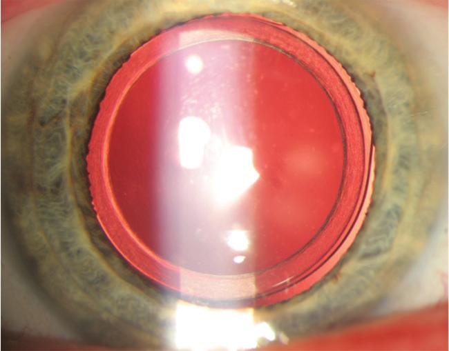 One is the use of the anterior capsulotomy for IOL fixation, which is now possible thanks to the advent of femtosecond laser systems for cataract surgery and tracking systems such as Callisto Eye