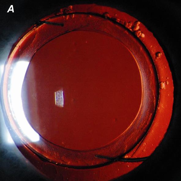 Optical Performance of Spherical and Aspheric Intraocular Lenses were retrieved by averaging the item scores (ranging from 0 to 100) within the subscales.