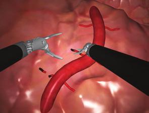 A Variety of Comprehensive Exercises Developed in collaboration with Mimic Technologies, the Skills Simulator exercises range from basic to advanced and are designed to be relevant to surgeons from