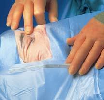 sterile field, which increases the risk of Surgical Site Infection. That is why a drape that is impervious to liquid is so important.