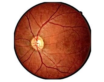 And a red filter emphasizes the choroid, which is useful for visualizing pigmentary disturbances, choroidal ruptures, choroidal nevi, and choroidal melanomas.