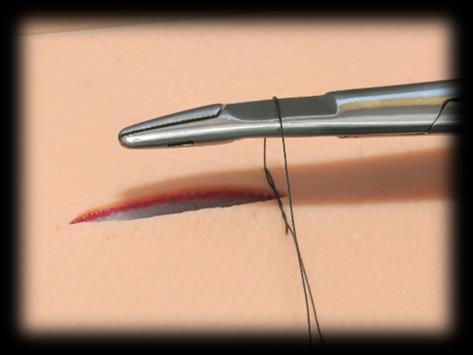 The suture should be tight enough to appose the wound edges but not too tight to cause discomfort.