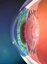 Preventing Post-Cataract Extraction CME: Early identification of patients at risk and prophylactic treatment may avert vision loss.