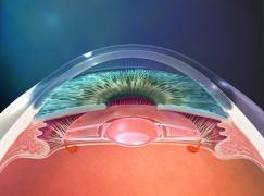 Accommodating Lens As objects move closer to the eye The ciliary muscle expands exerting pressure on the