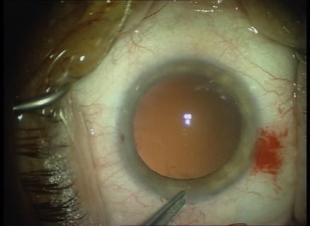 25 D) Post-Operative Refraction Pearls In the initial post-operative period, the accommodative change between distance and near may be slow.