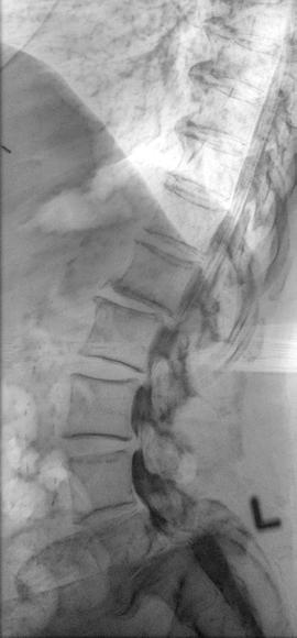 Each and every single frame is fully processed, without significant additional computation time (below 14 ms for fluoroscopy, below 55 ms for exposures), even at very high