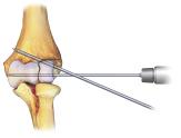 Surgical technique* 1) Reduce and stabilize the fracture. 2) Insert two diverging 1.5 mm or 2.