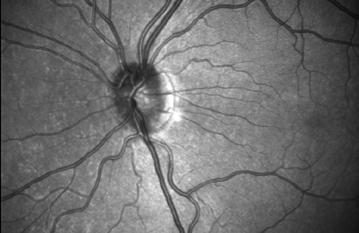 RETINAL SCANNER THAT FITS IN A PURSE In medicine detailed retinal images (see figure below) are captured by scanning laser ophthalmoscopes (SLO) which use a quickly moving laser spot illuminating the