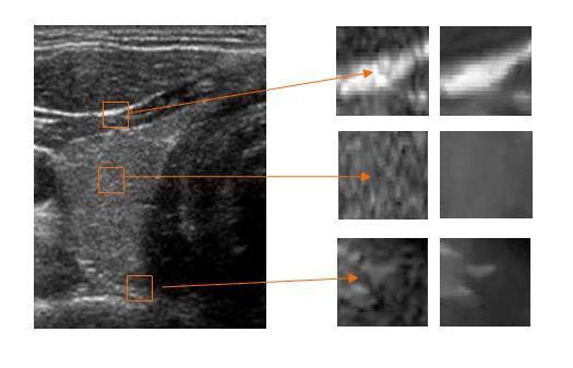 Post-Acquisition Technologies Speckle reduction imaging Adaptive, real-time software algorithm Preserves borders where echogenicity differences