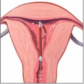 Mirena în segmentul uterin