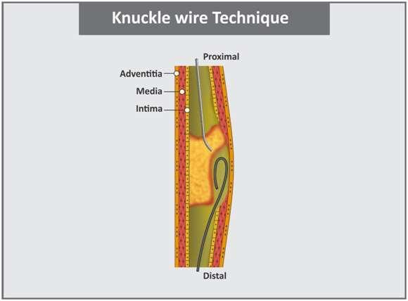 What is benefit of knuckle wire technique?