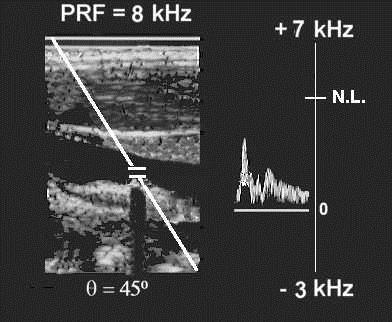 PW - ALIASING Example: The PRF is 8 khz, the Nyquist Limit is 4 khz. The Doppler shift does not exceed the Nyquist Limit.