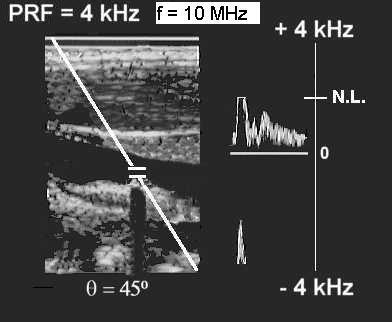 PW - ALIASING Example: The PRF is still 4 khz, the Nyquist Limit is still 2 khz.