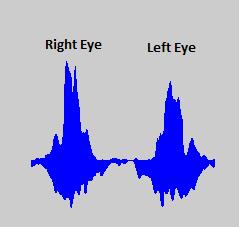Further, if one eye is blinked by keeping second eye opened then pixels motion is shown more in the eye area which is performing the wink as compared to the second eye. II.
