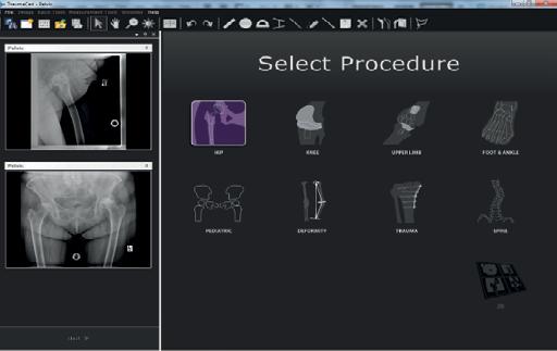 SELECT IMAGES SELECT PROCEDURE Select the image you want to evaluate for preoperative planning by clicking its