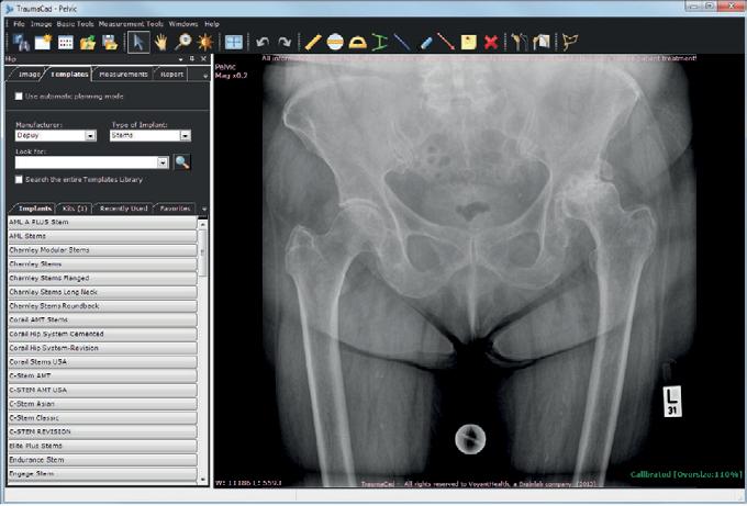 PLAN YOUR SURGERY On the left panel, you can navigate between the 4 tabs: Image - define image orientation and calibrate it Templates - insert tamplates to