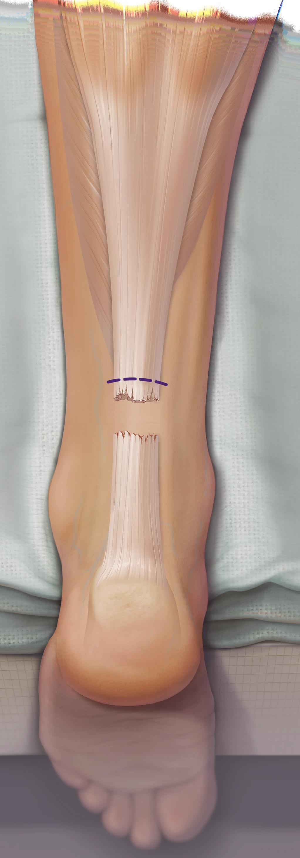 The PARS system provides the opportunity for consistently reliable capture of the proximal and distal aspects of the Achilles tendon and utilizes color-coded FiberWire suture.