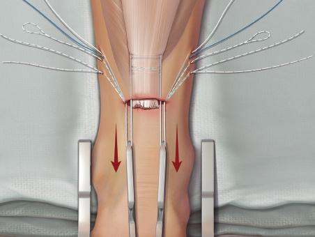 1 Illustration showing all of the sutures