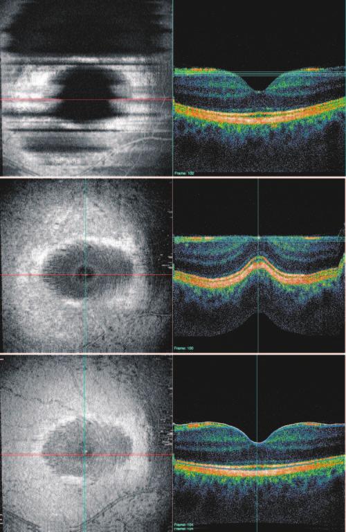 imaging speed of 25,000 axial scans per second, whereas the Cirrus OCT (Carl Zeiss Meditec) had 5- m resolution and a speed of 27,000 axial scans per second.
