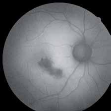 FAF has proven to be very useful for the early detection of age related Macula Degeneration (AMD), one of the
