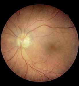 Canon Opacity Suppression When obtaining retinal images, ocular opacities can cause several problems.