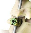 The Lineum OCT Spine System comes complete with standard rod-to-rod cross connectors and head-to-head cross connectors in