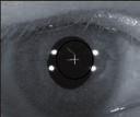 Auto anterior eye alignment and tracking The OCT-HS100 will automatically maintain the exact alignment on