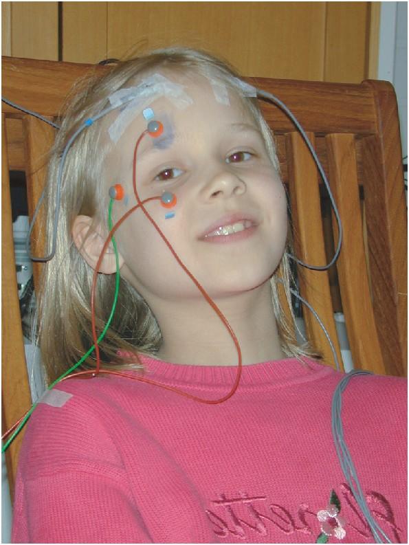 EEG channel types Bipolar (differential) channels a dedicated pair of electrodes (+ and ) for each channel for EOG (electrooculogram; monitoring of eye movements and blinks) and EMG (electromyogram;
