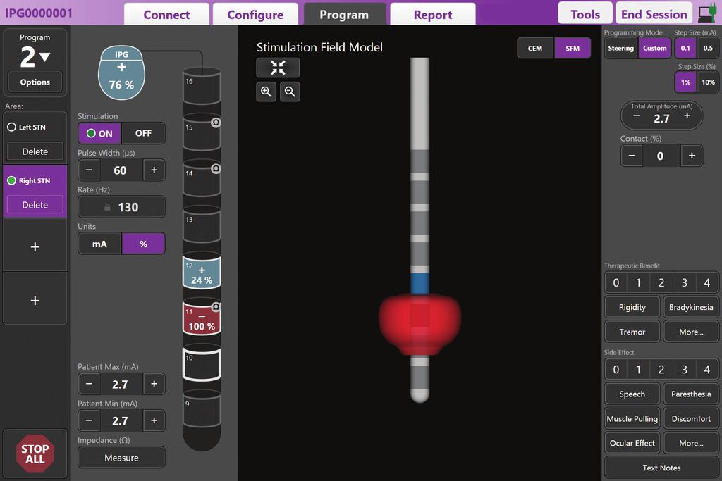 CUSTOM MODE MAPPING THE PATIENT S CLINICAL EFFECTS OF STIMULATION Custom Mode allows you to assign anodic or cathodic stimulation to individual contacts and case.