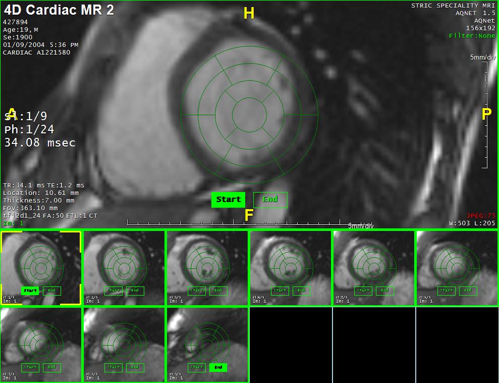 Chapter 6 Cardiac MR The sorted series is routed back to the Series List. Figure 6-3: Sorted Data Loaded Cine Tools Note: Non-uniformly spaced volumes are not supported.